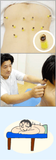 きゅう、小児鍼、自由施術-古川鍼灸接骨院
